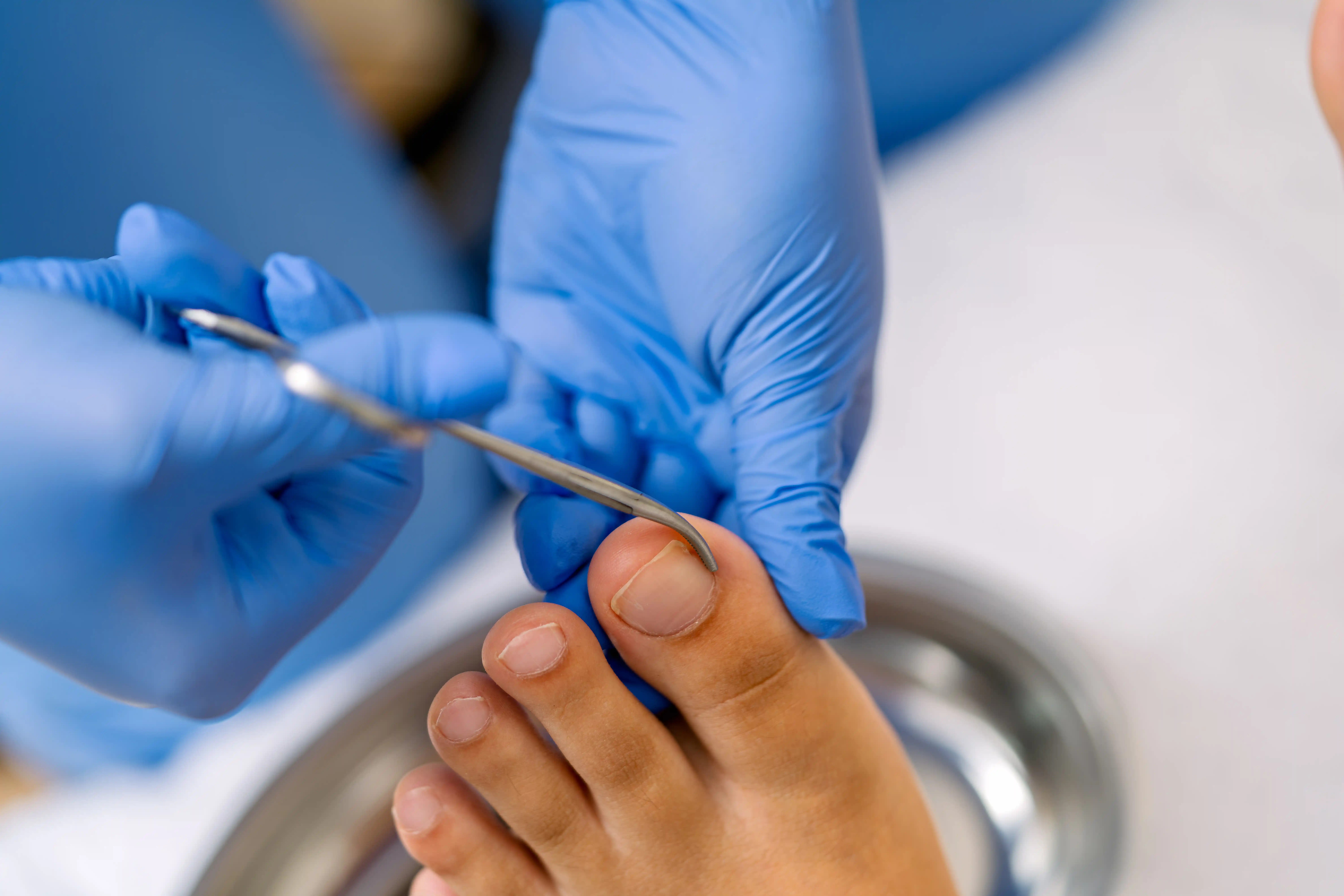 Ingrown Toenail Specialist