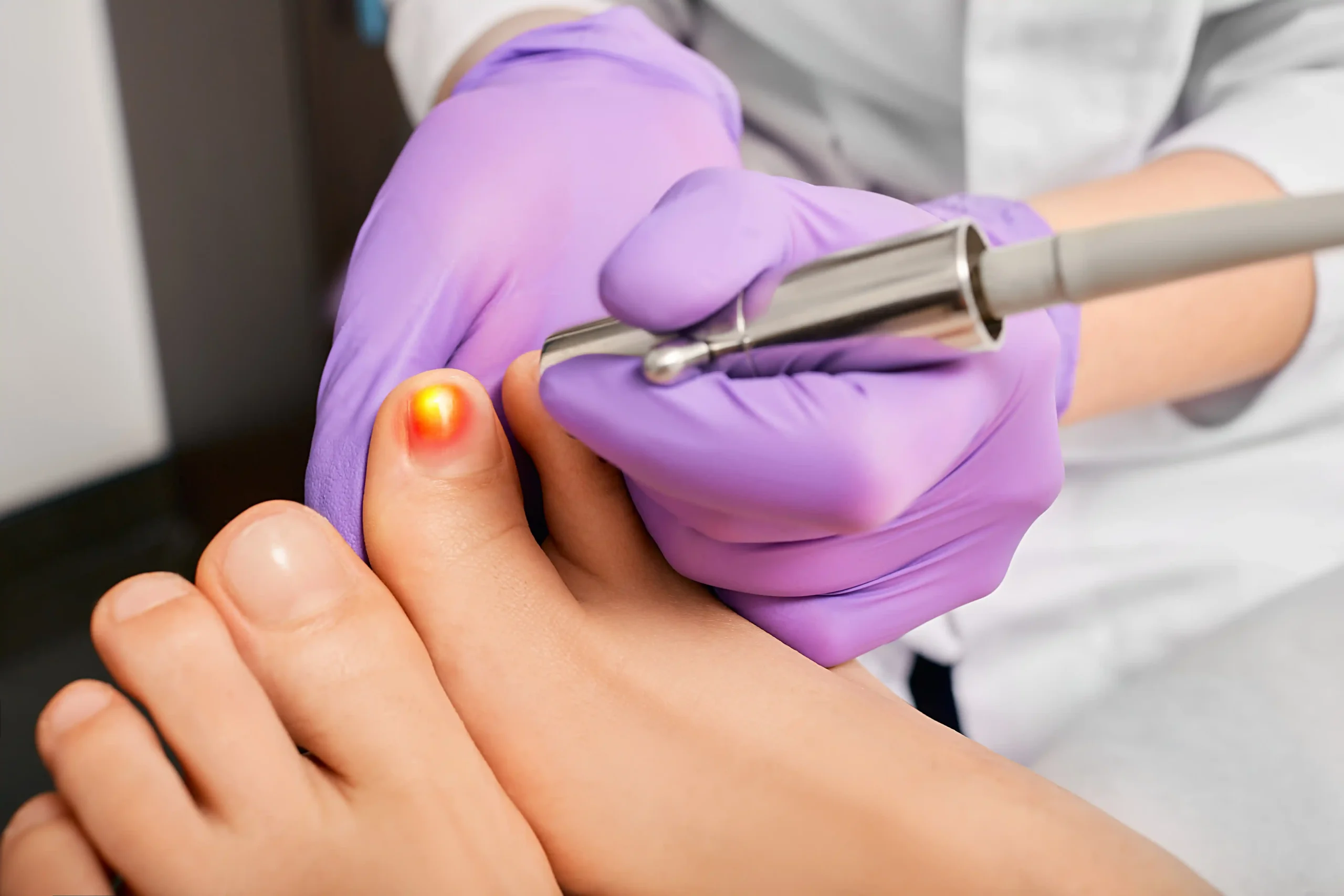 Nail Fungus Specialist